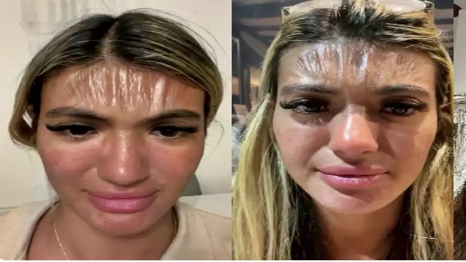 Woman slept on the beach in strong sunlight her forehead shrank like plastic