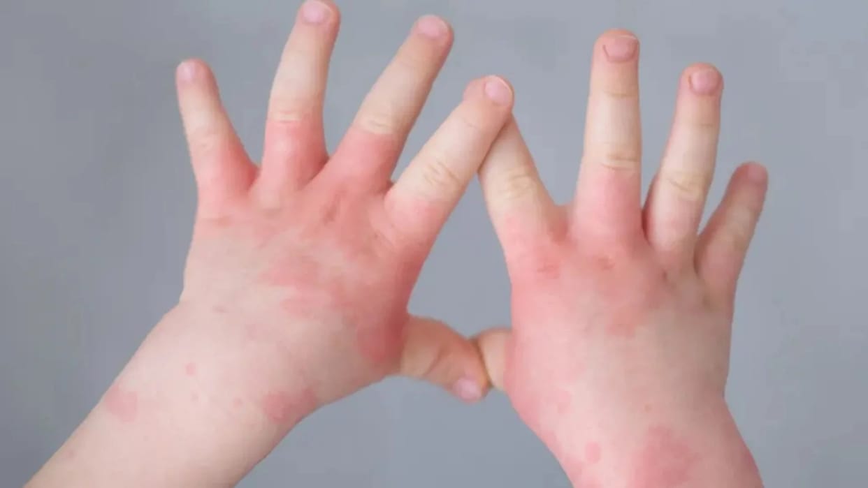 Tomato flu symptoms being found in 10 to 12 patients daily