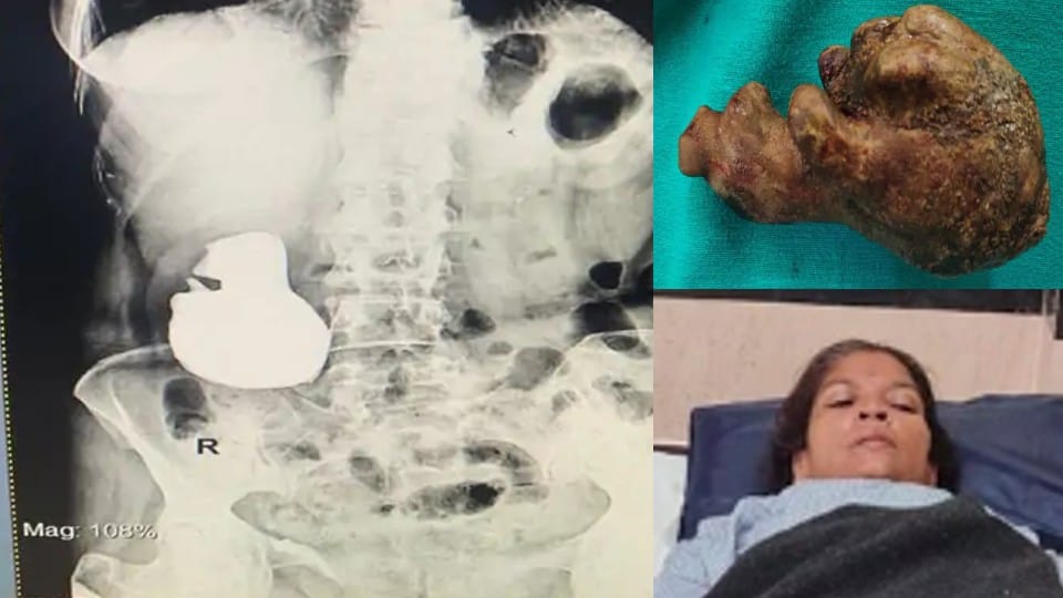 Dewas: 12.5 cm stone removed from woman's kidney, claim - world's second case of removing such a big stone