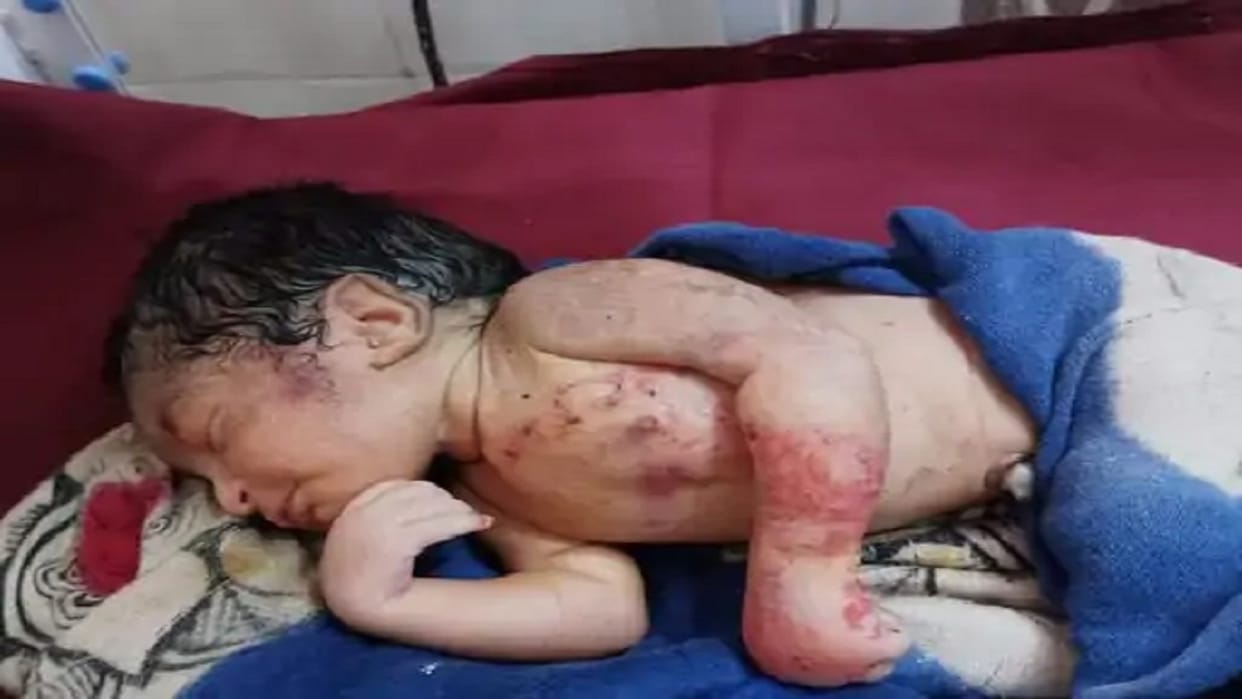Newborn girl found from a pile of garbage wounds on the body were caused by the bites of ants