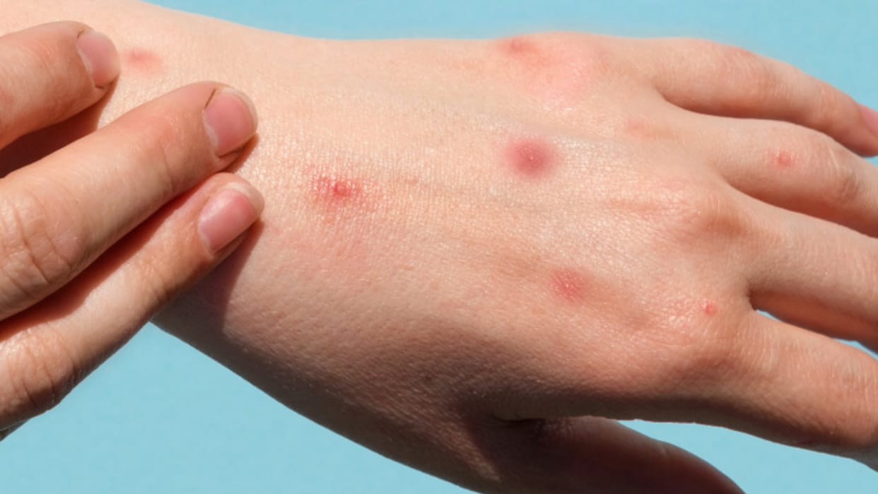 Monkeypox suspected patient condition deteriorated KGMU referred