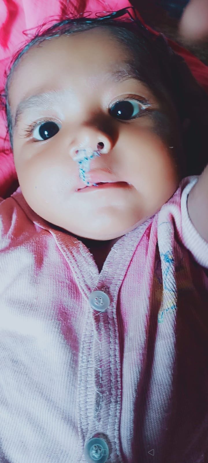 After surgery, the problem went away, Shivam started drinking mother's milk