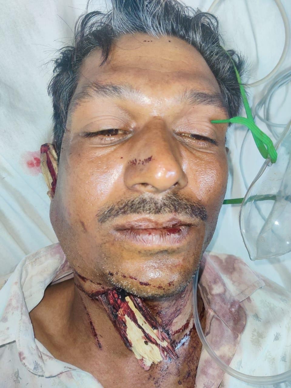 The doctors saved the patient's life by severing the neck and removing a 20 cm long piece that came out of the ear.