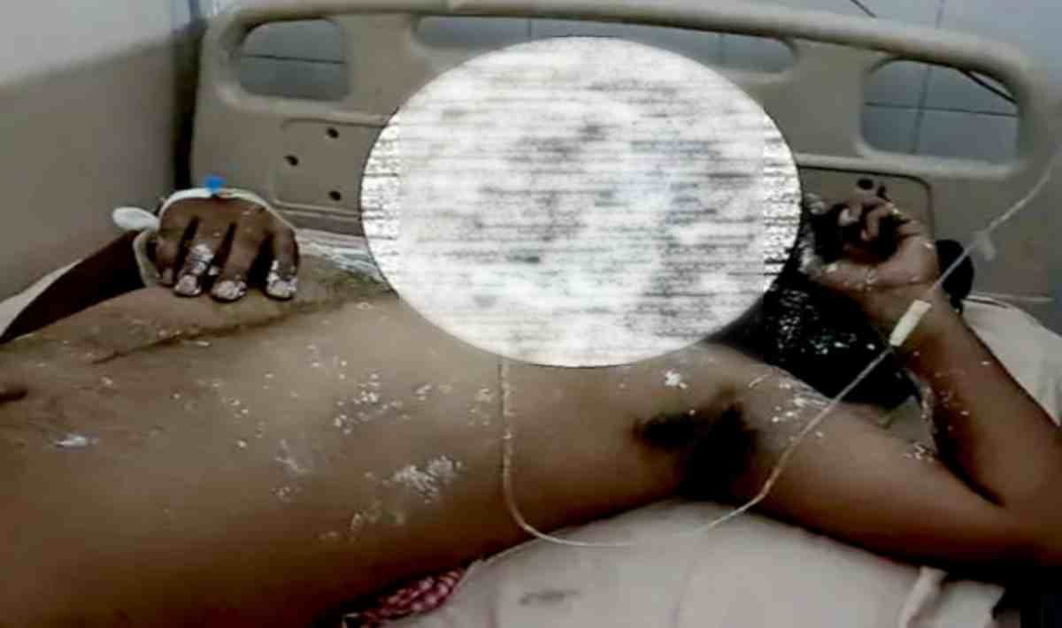Wife pours boiling oil on husband sleeping in Chandauli, condition critical
