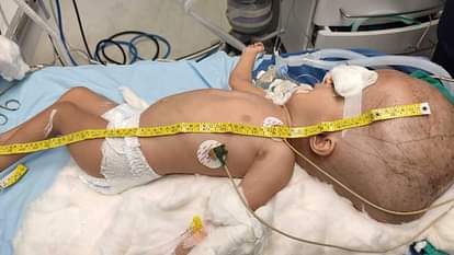 Exclusive RIMS doctors successfully operated enlarged head, know cognitive hydrocephalus details