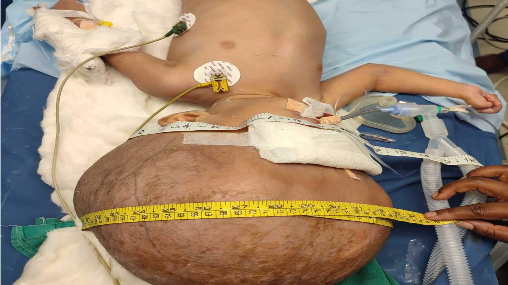 Exclusive RIMS doctors successfully operated enlarged head, know cognitive hydrocephalus details