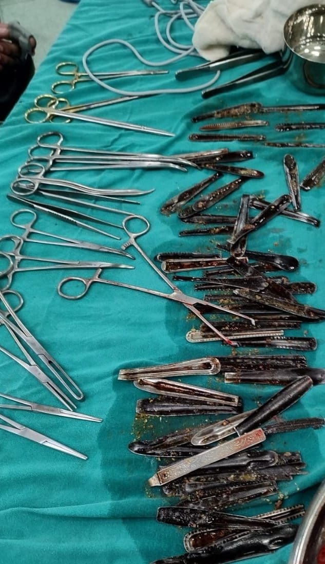 63 spoons came out of the stomach of the youth who returned from the drug de-addiction center