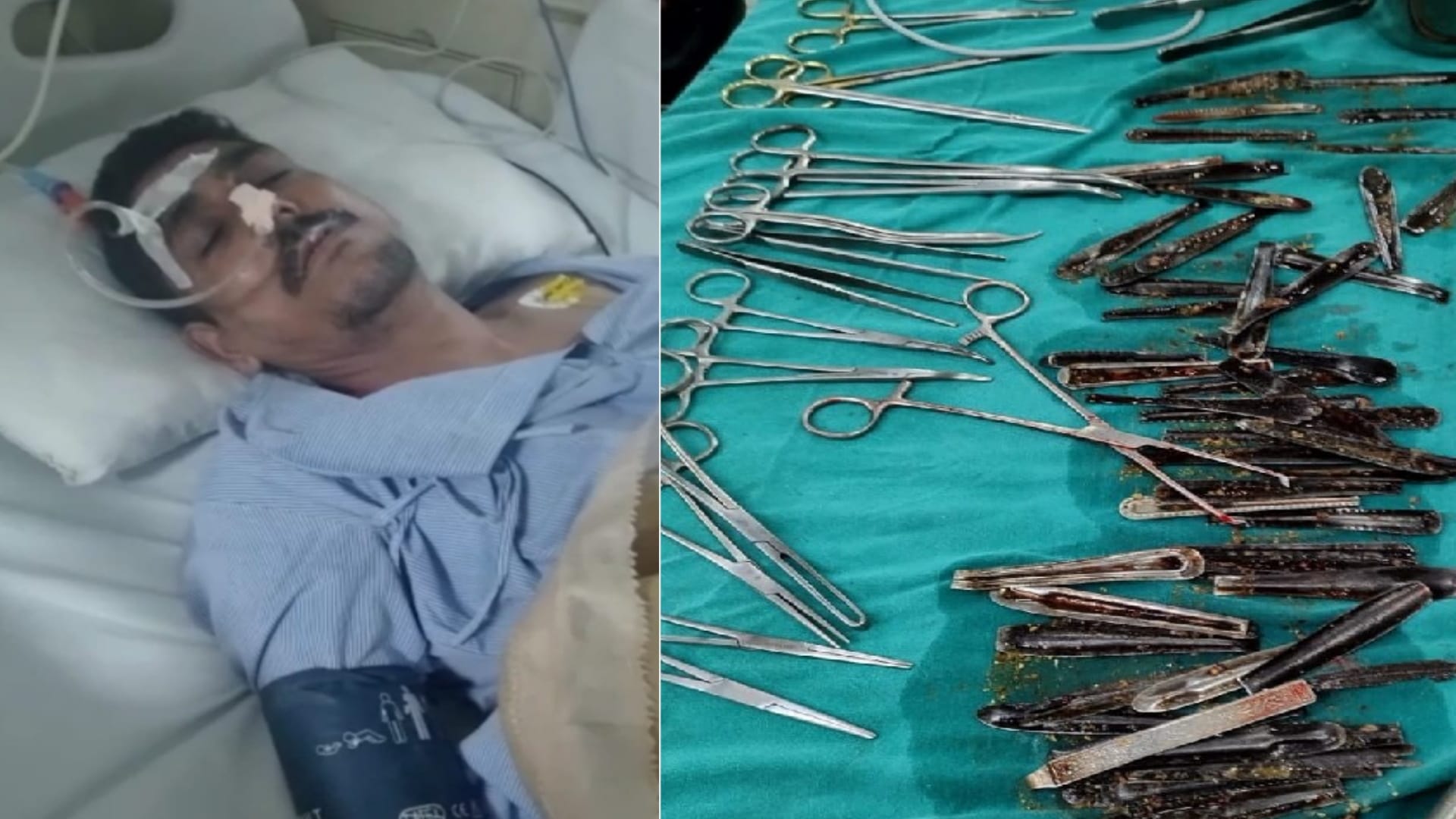 Doctors Removed more than Sixty Spoons from a man Stomach in Muzaffarnagar