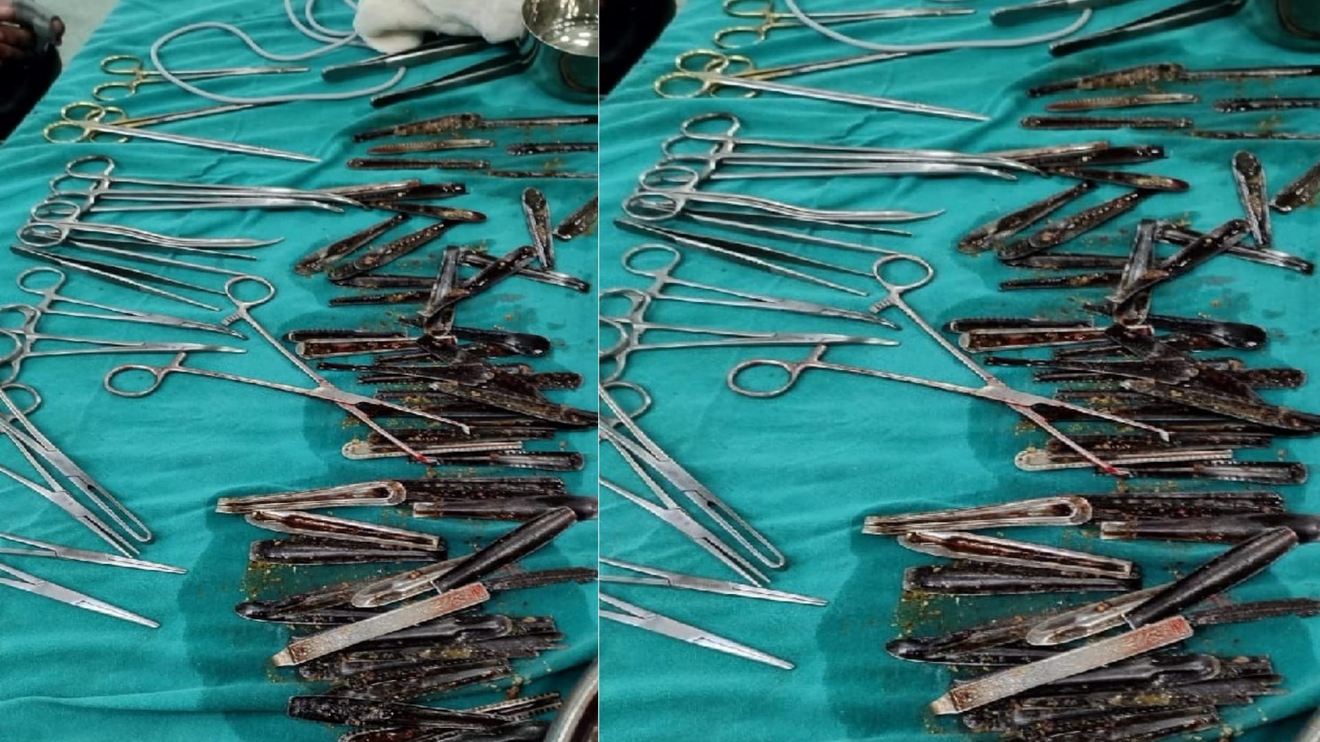 Doctors Removed more than Sixty Spoons from a man Stomach in Muzaffarnagar
