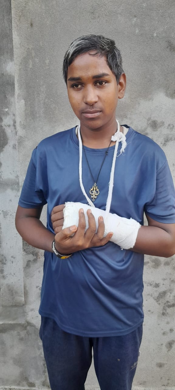 Fracture in hand of student due to beating of teacher