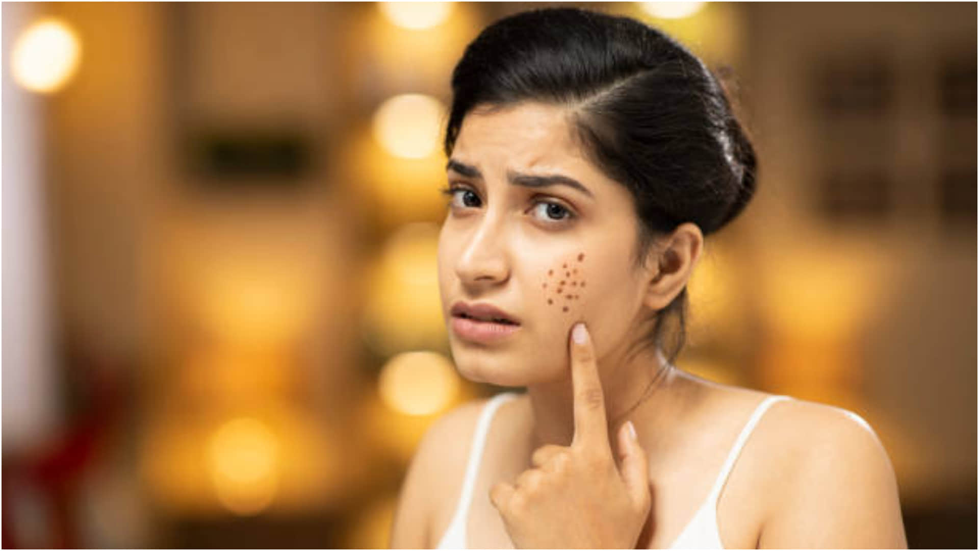 mint leaves for acne pimples and scars