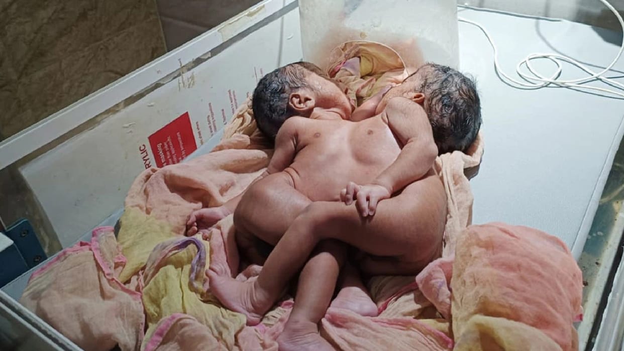 unique twins born in Nagaur who connected to chest