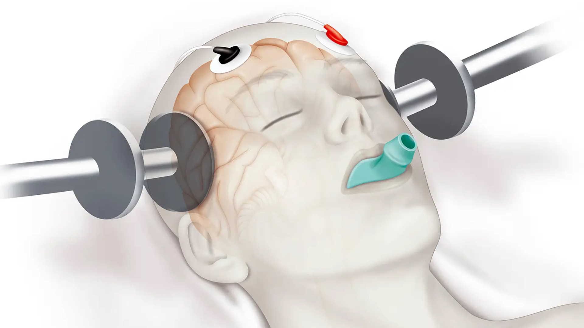 World Meantal Health Day2022, Electroconvulsive therapy (ECT) for severe depression know its procedure