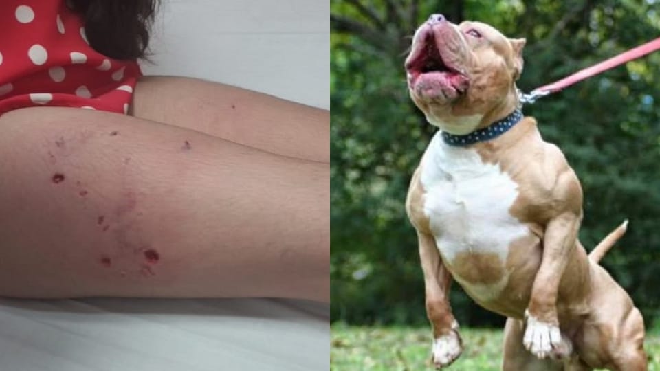 Pitbull attacked girl student in Ghaziabad bitten her leg in many places