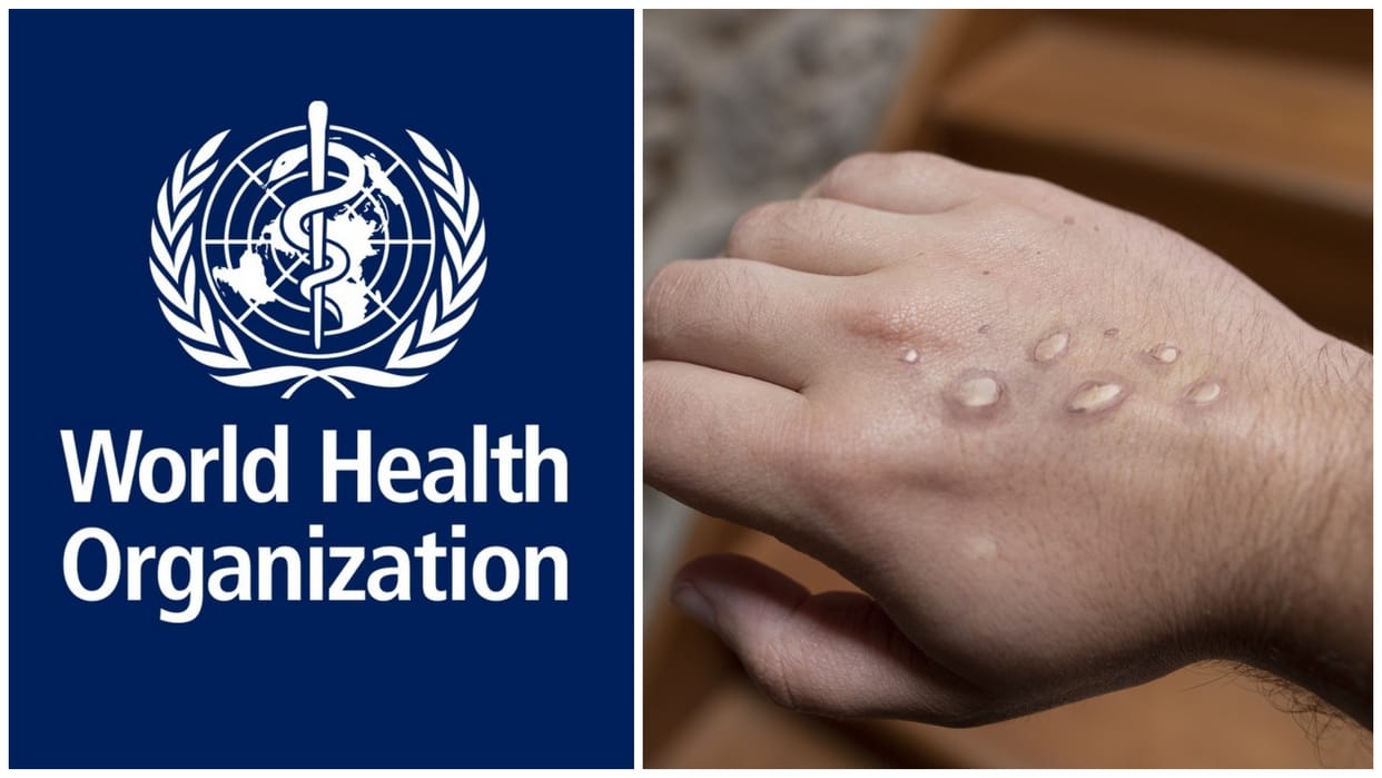 Monkeypox Cases globally crosses 70,000 mark WHO warns for dire times as America faces rises news in hindi