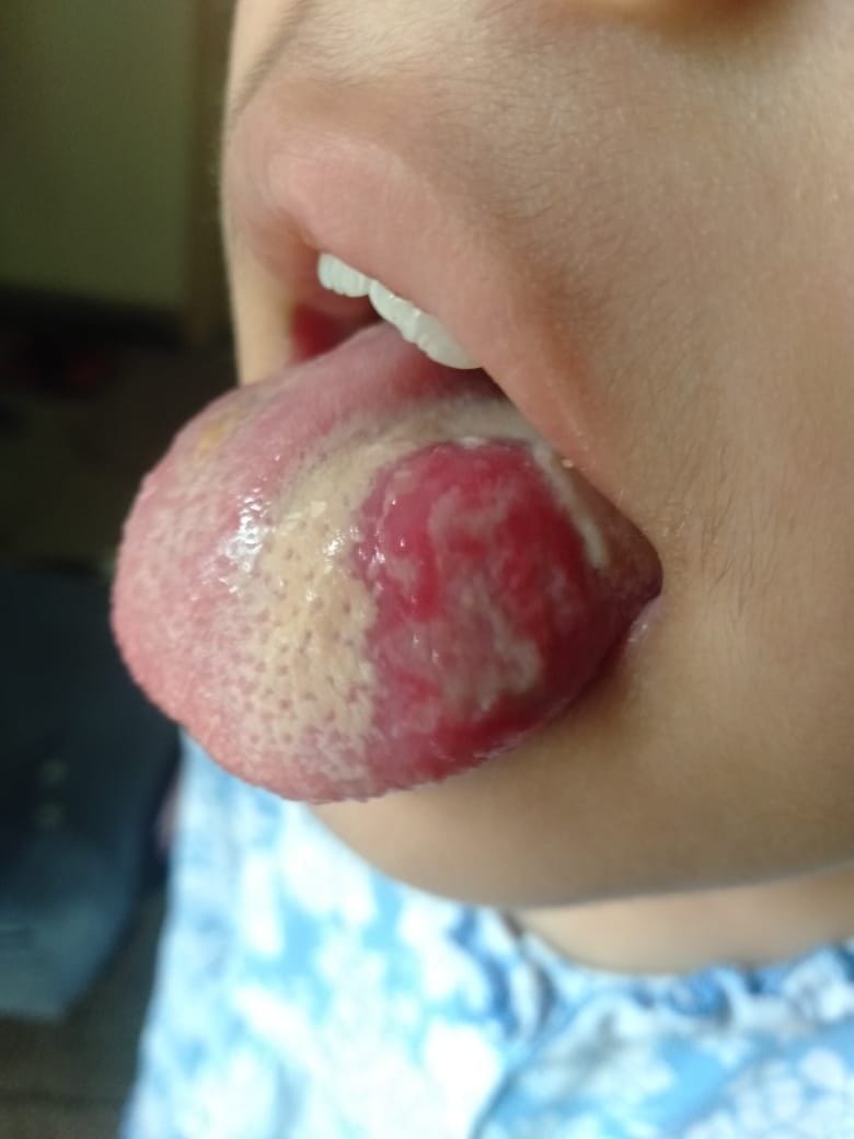 Now the condition of 6 year old girl deteriorated in PGI after dental treatment