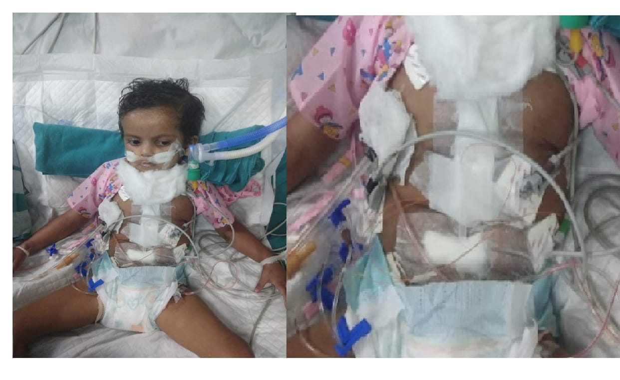 Successful and free surgery in Aligarh for two holes in Avni's heart in Banda