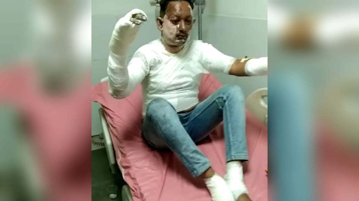 Wife's brothers burnt a young man who had a love marriage in the neighborhood by pouring petrol