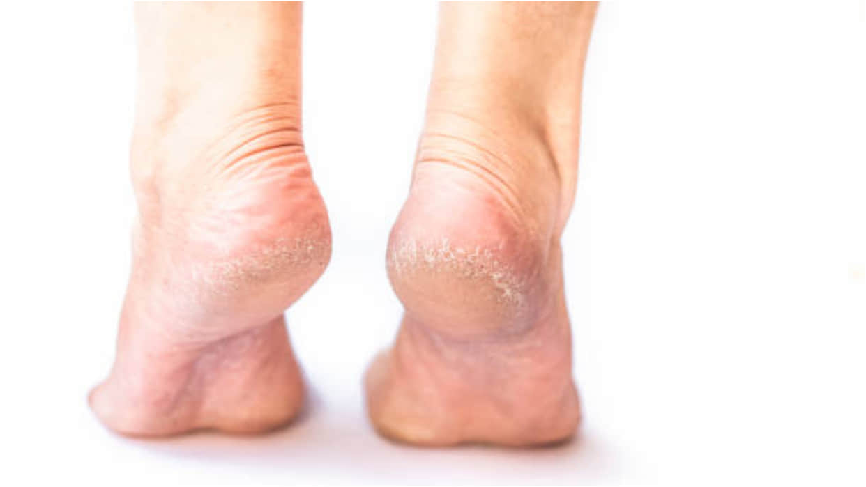Crack Heels Home Remedies Know How to Take Care Crack Heels With Hing Read More