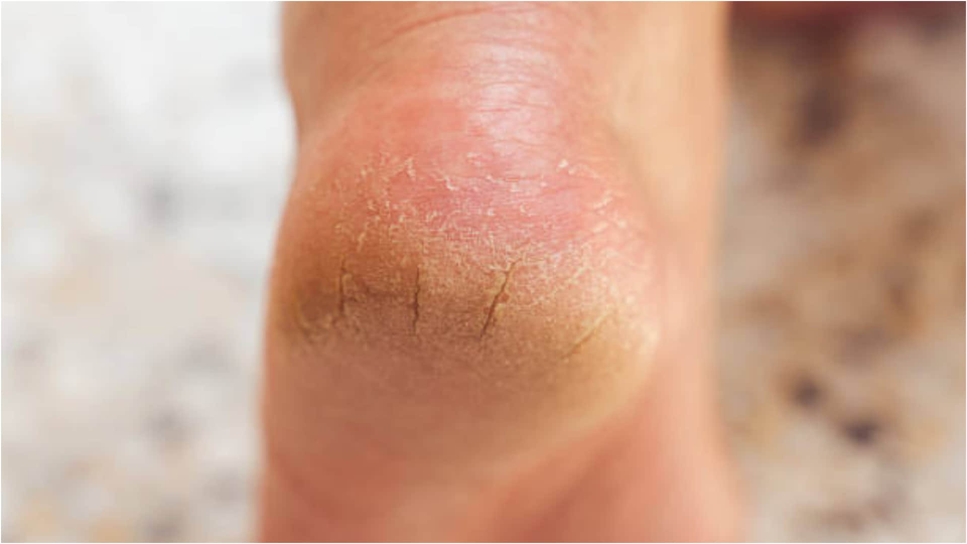 Crack Heels Home Remedies Know How to Take Care Crack Heels With Hing Read More