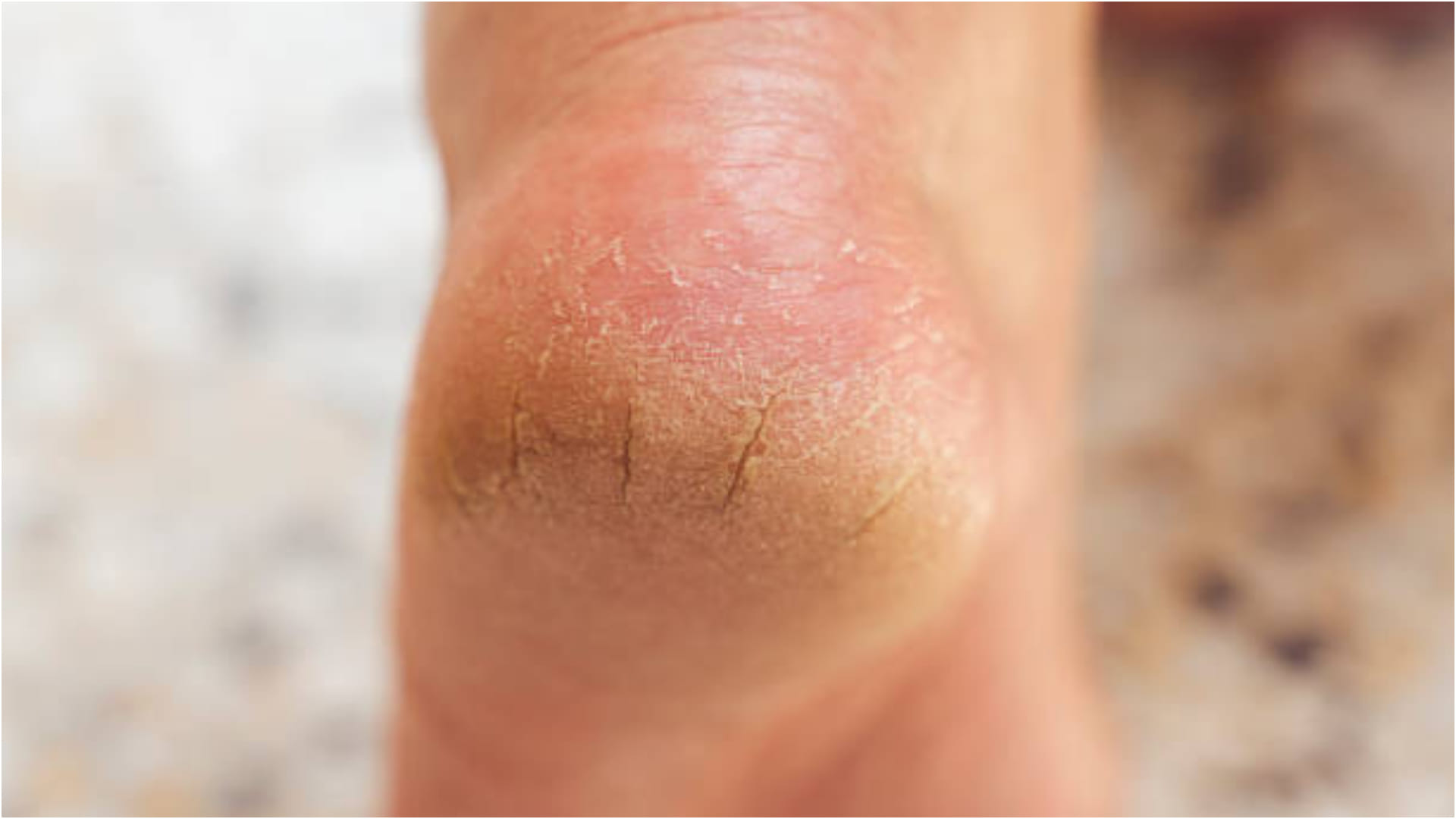 Crack Heels Home Remedies Know How to Take Care Crack Heels With Hing Read More