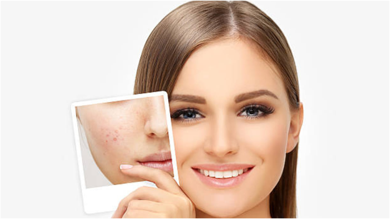 cucumber face pack for remove facial marks and acne scars