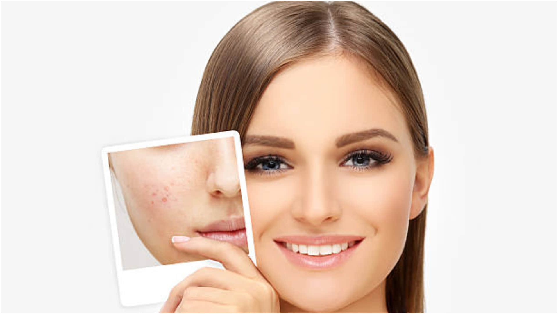 how to remove acne pimples pigmentation marks in two weeks tips in hindi