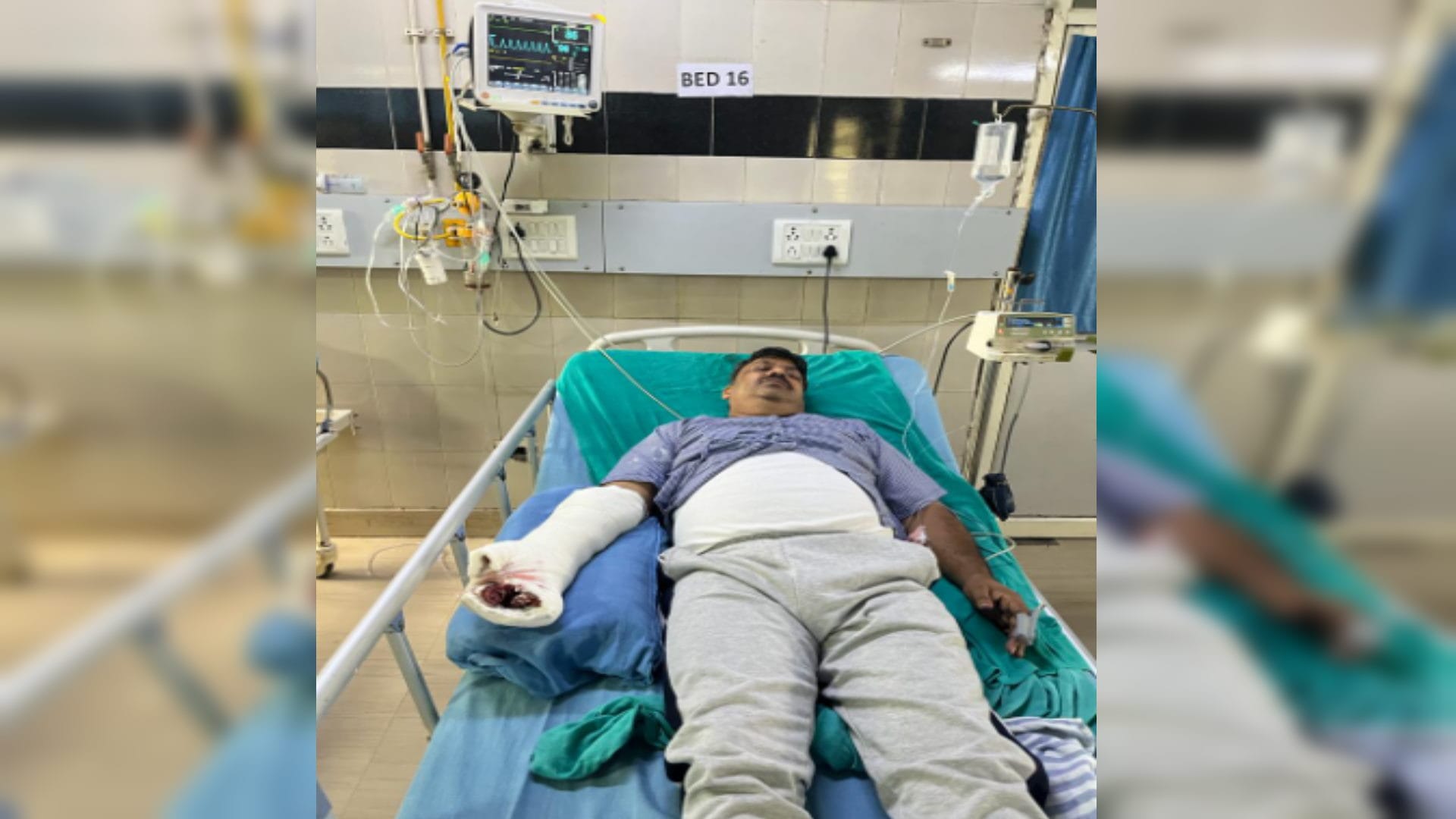 A dog attacked on inspector in Bijnor, got plastic surgery on hand in four hours