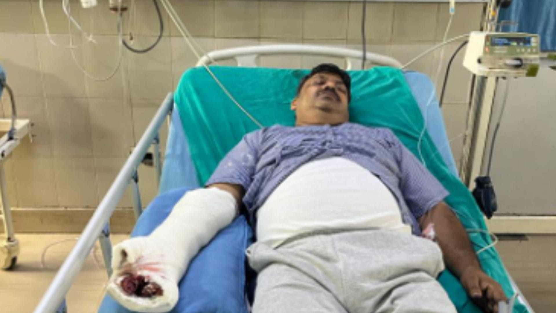 A dog attacked on inspector in Bijnor, got plastic surgery on hand in four hours