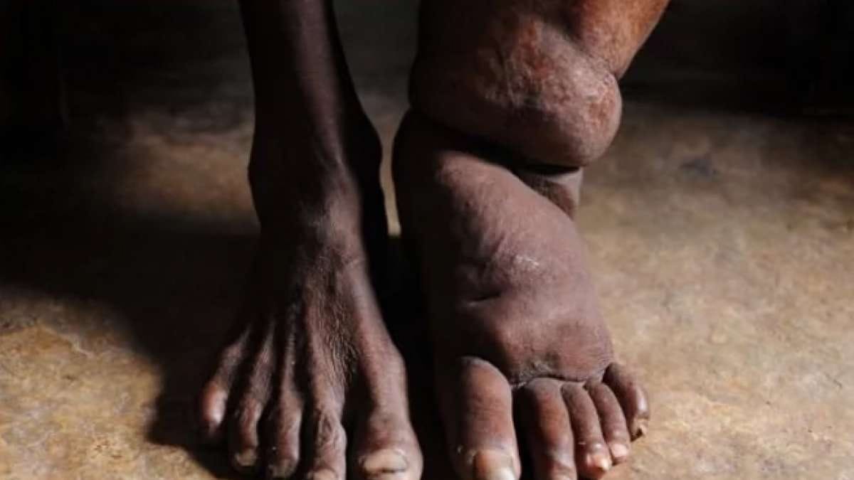 National Filariasis Day, one day's medicine will cure filariasis