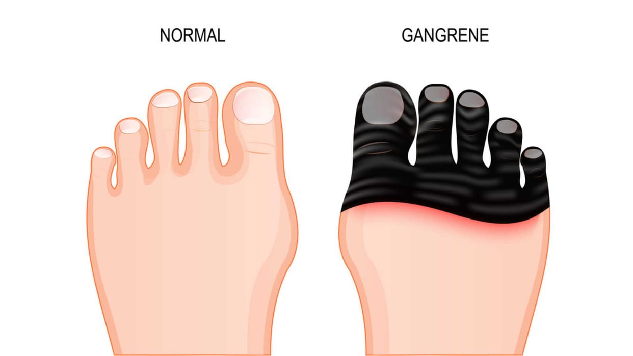 world diabetes day 2022, Uncontrolled Diabetes Can Harm Your Toes, Know Symptoms of diabetic foot ulcer