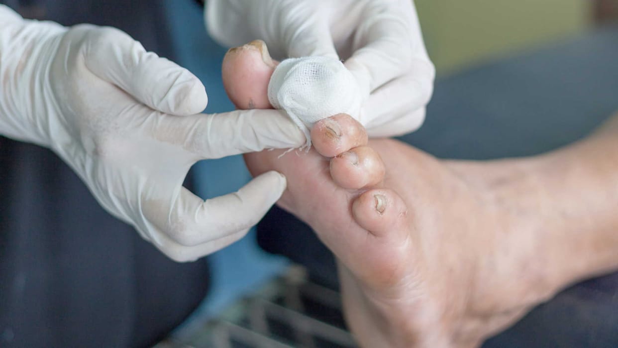 Angioplasty of diabetic foot, know what specialist say.