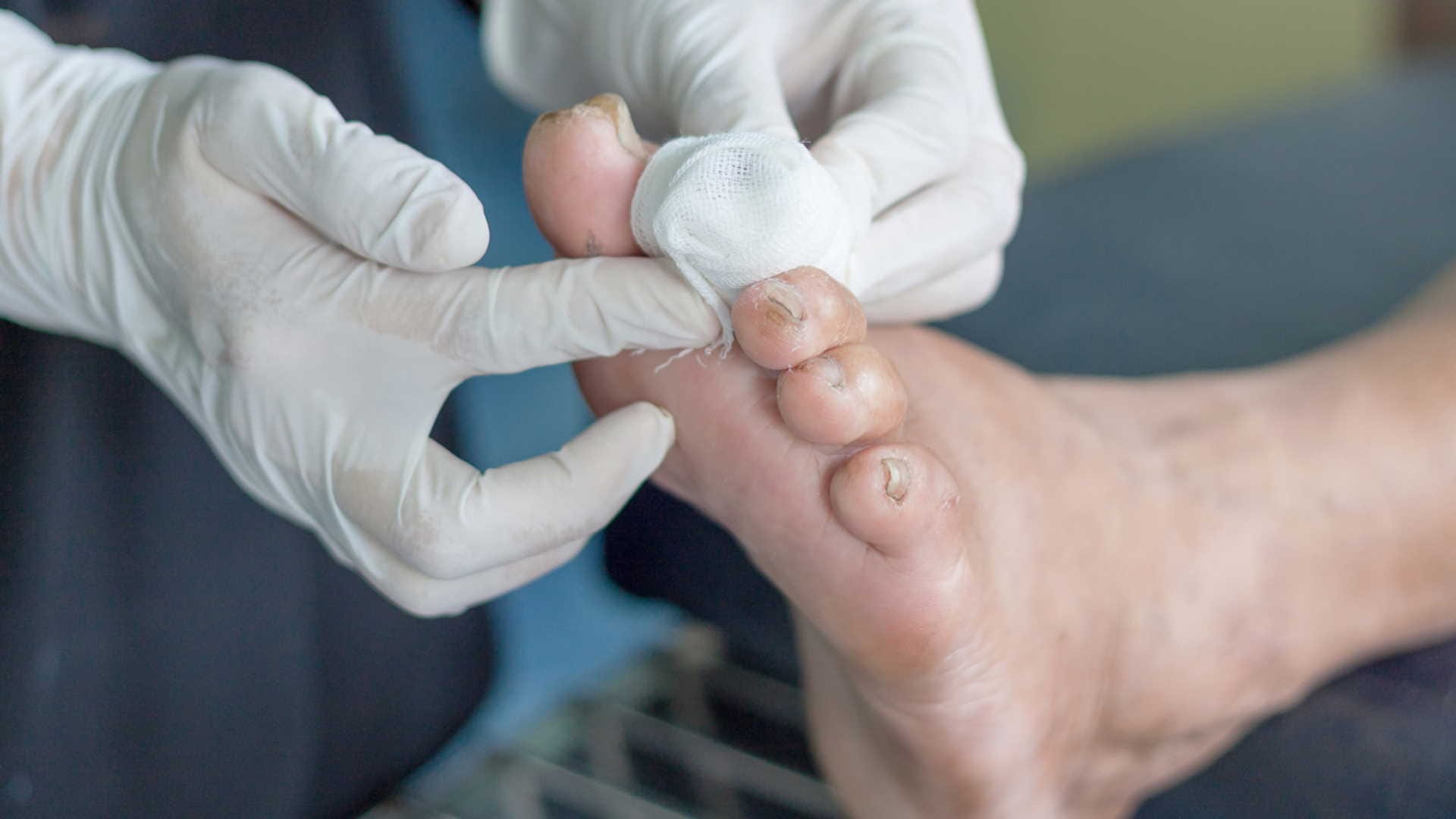 world diabetes day 2022, Uncontrolled Diabetes Can Harm Your Toes, Know Symptoms of diabetic foot ulcer