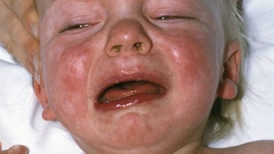Measles outbreak in Kerala government appeals to parents to vaccinate children