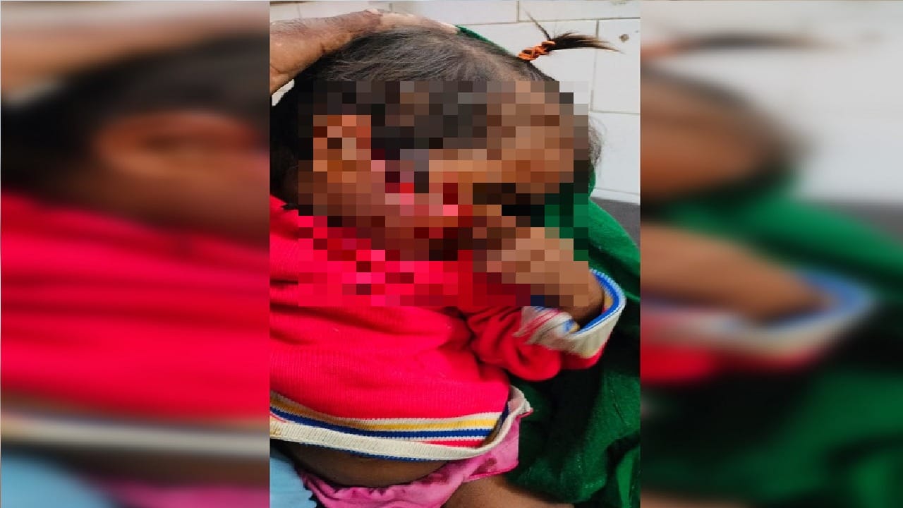 Dog scratched one year old girl face in Ghaziabad