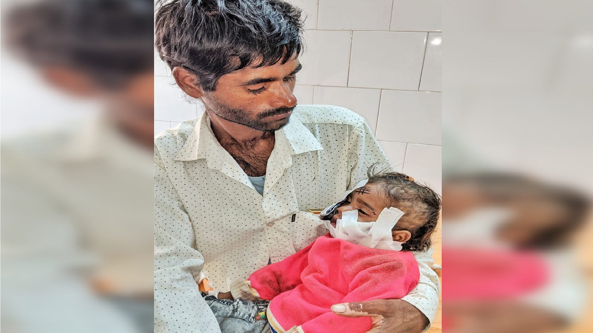 Dog Attack A one year old girl injured by dog in vijaynagar Ghaziabad got 115 stitches