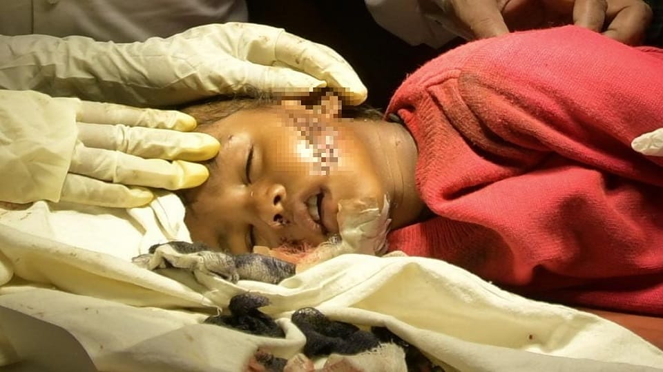 Dog Attack A one year old girl injured by dog in vijaynagar Ghaziabad got 115 stitches