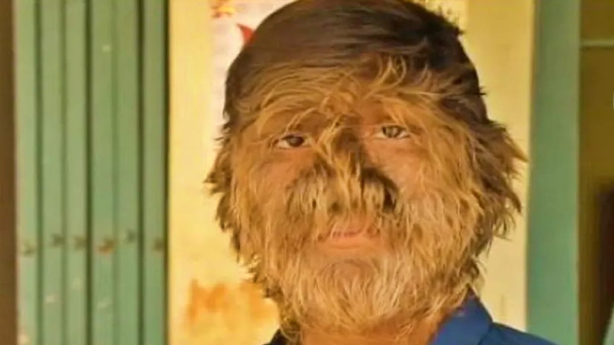 Ratlam Lalit Patidar who has long hair on his face People used to worship Hanuman