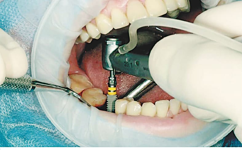 Shimla: dental college started  dental implant facility