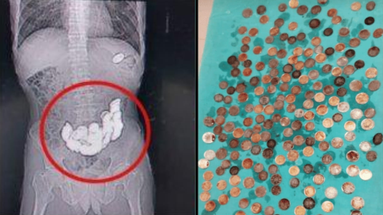Karnataka 187 coins came out of the patients stomach reached the hospital after complaining of stomach pain