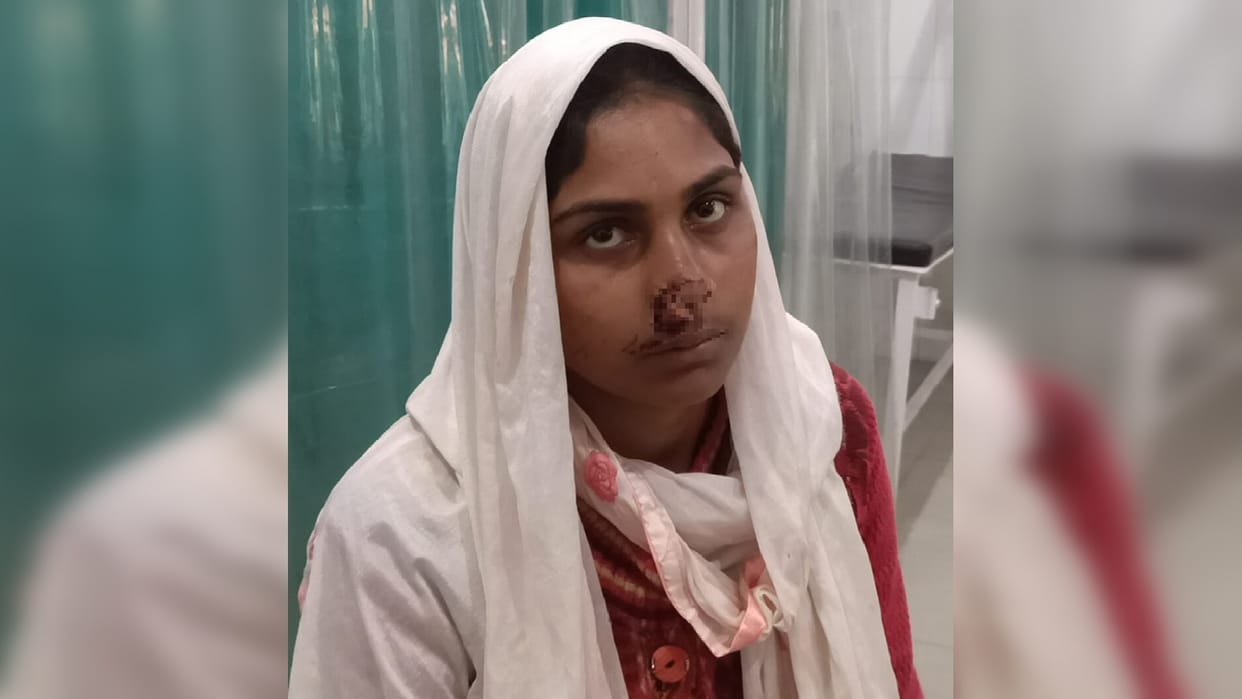 Husband cuts off wife s nose for opposing drink in Moradabad