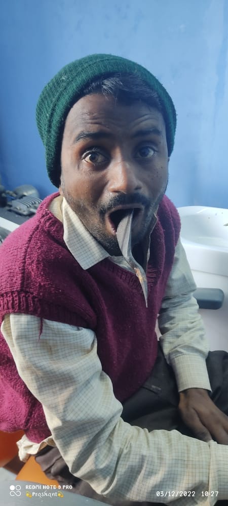 Gopalganj: He did something like this that a splinter got stuck in his mouth, life saved through operation