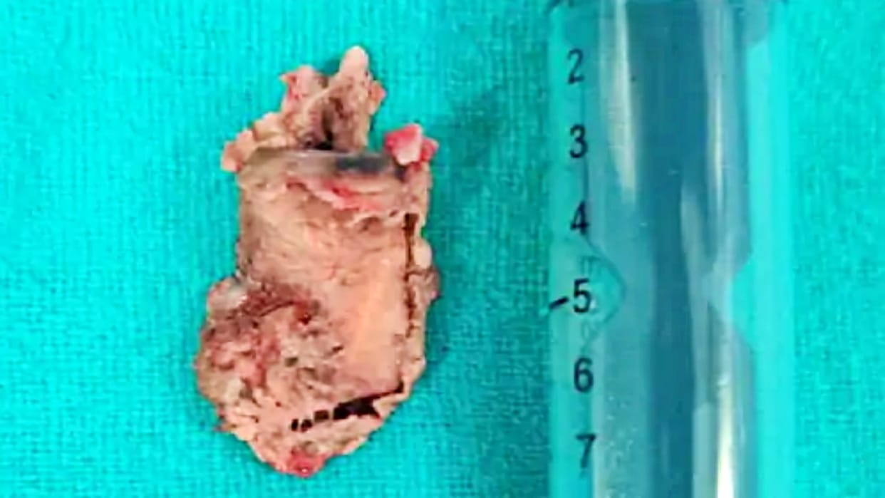Bronchoscopy Surgery Doctor Remove Four Cm Supari From Woman Neck in Jaipur SMS Hospital
