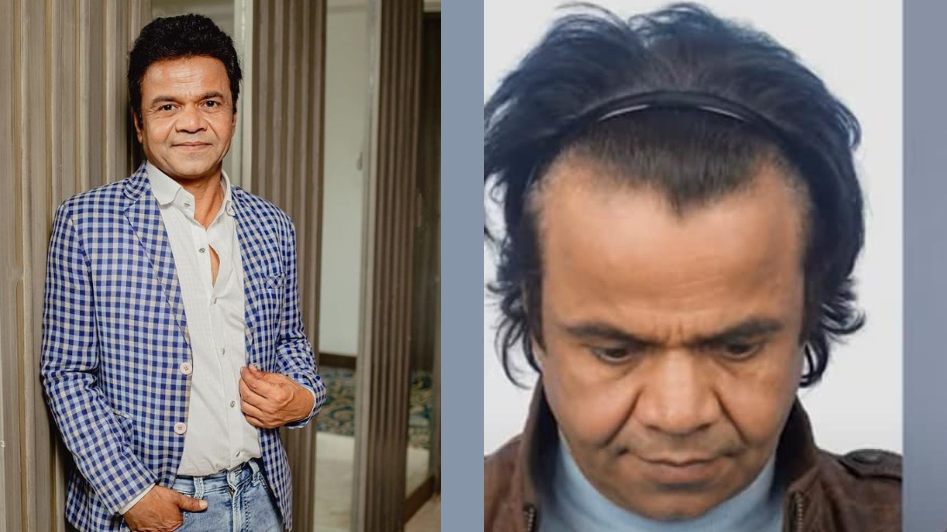 rajpal yadav undergoes hair transplant actor shares his experience