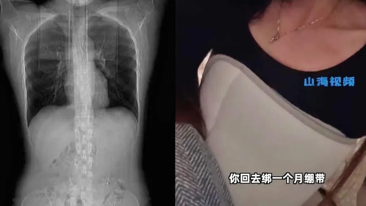chinese woman's ribs fractured Due to cough while eating spicy food china news In Hindi
