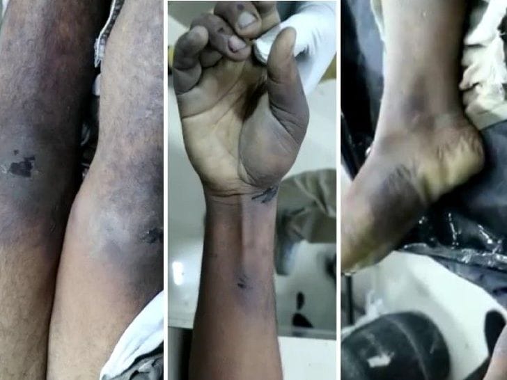 Kanpur Dehat: Police tied Balwant with a rope and beat him in Raniya police station, the skin was torn off, even doctors were shocked to see the injuries