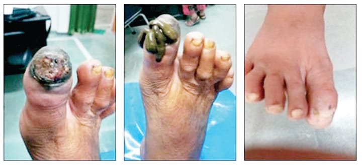 Leeches now suck many dangerous diseases