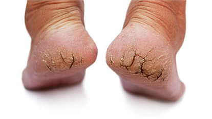 Crack Heels Remedy Know Effective Homemade Remedies for Crack Heels in Hindi