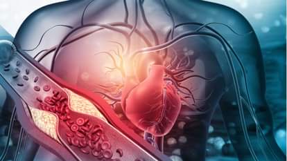 what causes artery blockage What lifestyle leads to arteries problems