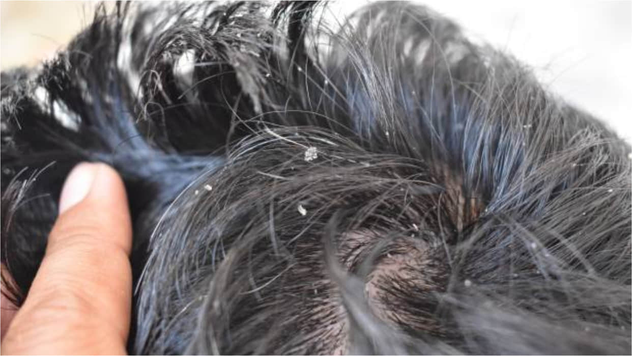 Dandruff Home Remedies How To Use Lemon To Get Rid Of Dandruff In Winters